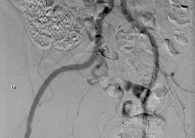 04 CO2 Angiographie mit Kontrastmittelinjektor Inspect 3005R