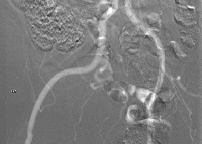 05 CO2 Angiographie mit Kontrastmittelinjektor Inspect 3005R