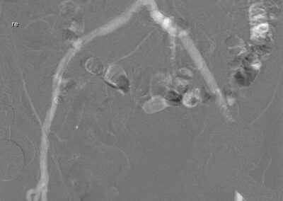 10 CO2 Angiographie mit Kontrastmittelinjektor Inspect 3005R