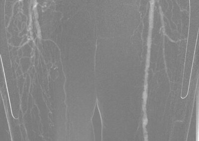 12 CO2 Angiographie mit Kontrastmittelinjektor Inspect 3005R