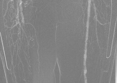 12 CO2 Angiographie mit Kontrastmittelinjektor Inspect 3005R