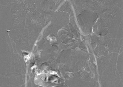 16 CO2 Angiographie mit Kontrastmittelinjektor Inspect 3005R